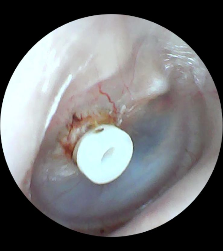 Tubinho de Ventilação: Entenda o Procedimento, Benefícios e Indicações